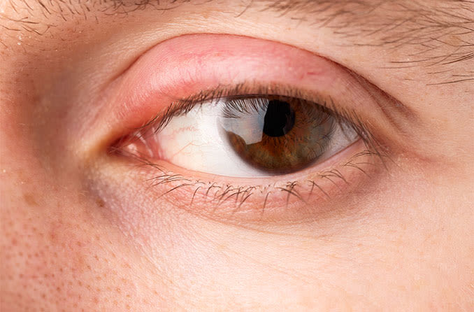 Slight Eyelid Swelling