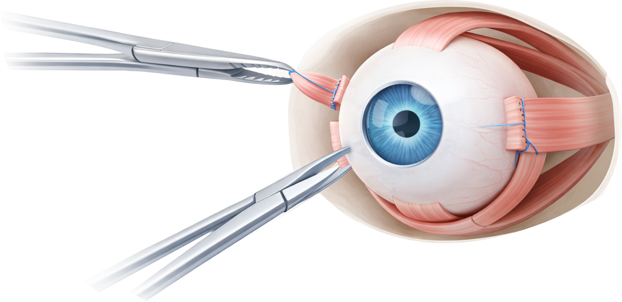 Surgical Technique